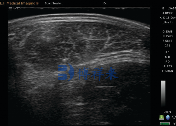 高清牛眼肌超声影像